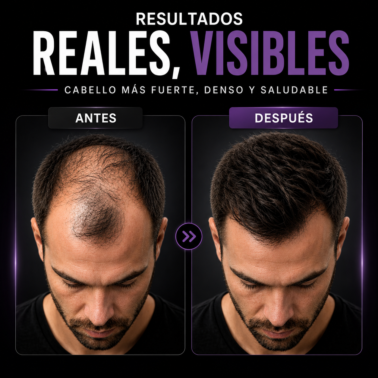 Fortalecedor Capilar para Cabello Débil y Quebradizo - ¡Reduce las entradas y la caída del cabello!